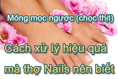 Móng mọc ngược hay móng chọc thịt – Cách xử lý hiệu quả mà thợ Nails nên biết