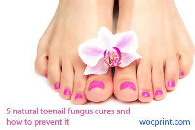 5 natural toenail fungus cures and how to prevent it