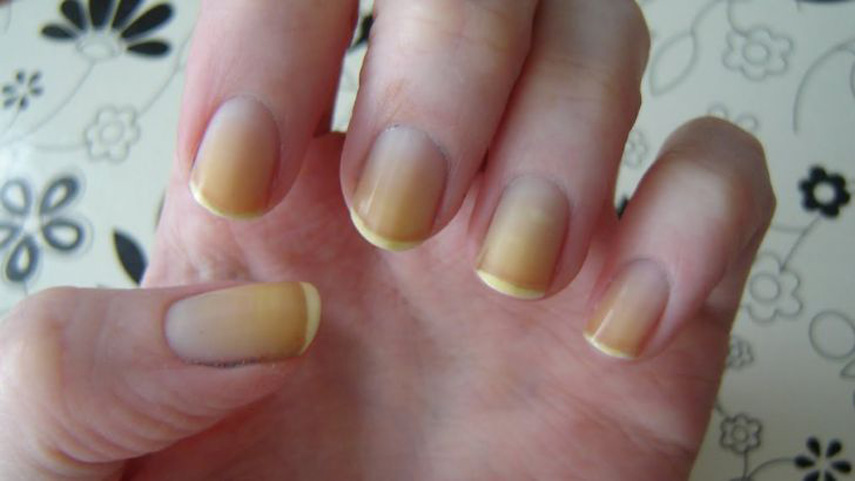 ingernails-and-health-signs-10-Signs-that-could-be-showing-you-underlying-health-problems-2