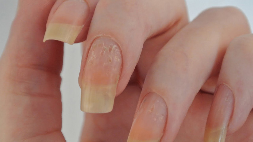 ingernails-and-health-signs-10-Signs-that-could-be-showing-you-underlying-health-problems-3