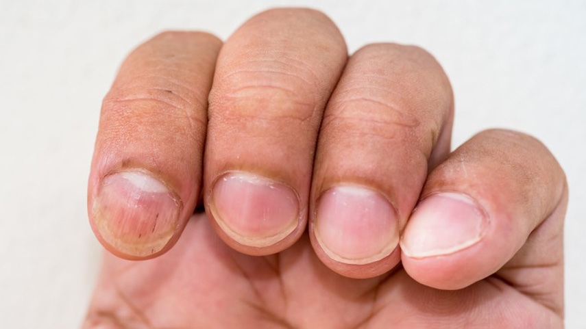 ingernails-and-health-signs-10-Signs-that-could-be-showing-you-underlying-health-problems-4