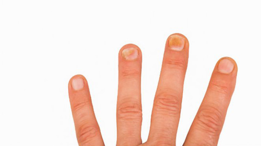 ingernails-and-health-signs-10-Signs-that-could-be-showing-you-underlying-health-problems-5