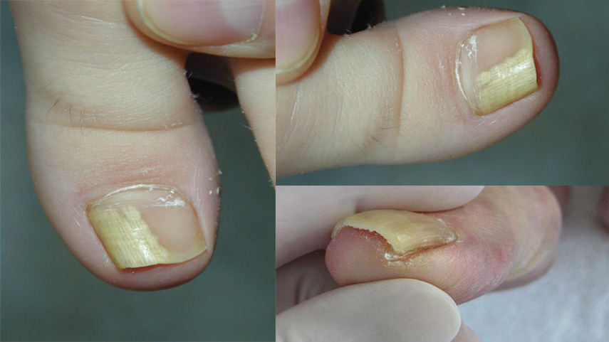ingernails-and-health-signs-10-Signs-that-could-be-showing-you-underlying-health-problems-6