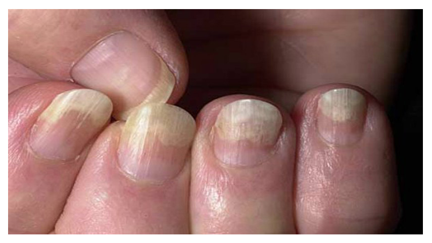 Fingernails And Health Signs 10 Signs That Could Be Woc Print 