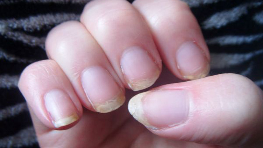 ingernails-and-health-signs-10-Signs-that-could-be-showing-you-underlying-health-problems-8