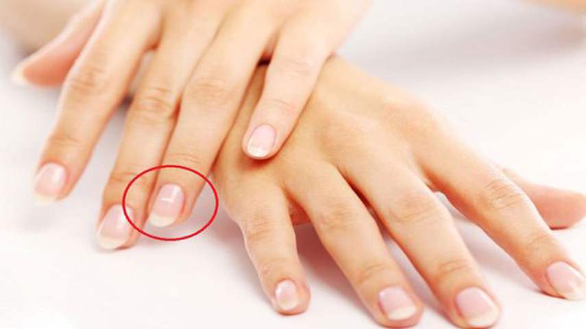 ingernails-and-health-signs-10-Signs-that-could-be-showing-you-underlying-health-problems-9