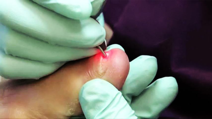 how-dose-laser-treatment-fungal-toenails-cost-and-how-does-it-work-1