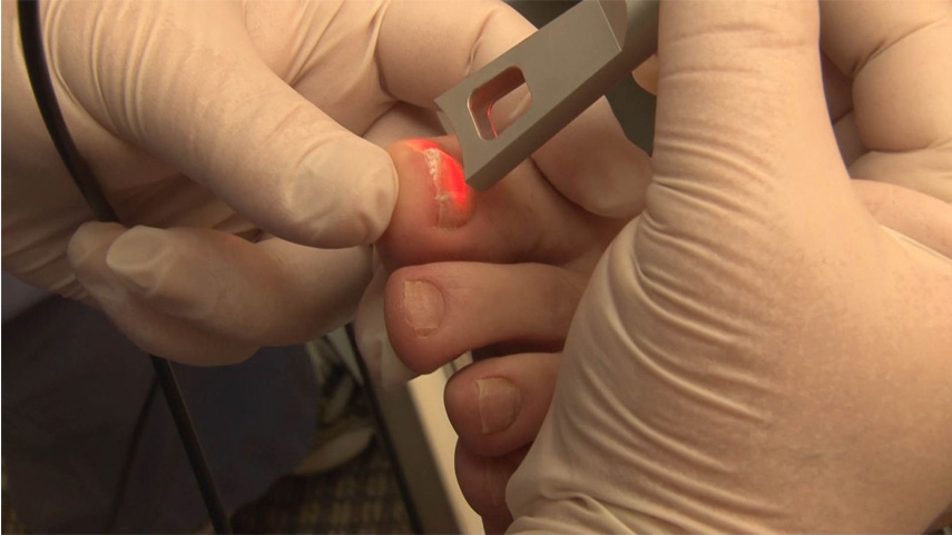 how-dose-laser-treatment-fungal-toenails-cost-and-how-does-it-work-2