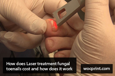 How does Laser treatment fungal toenails cost and how does it work