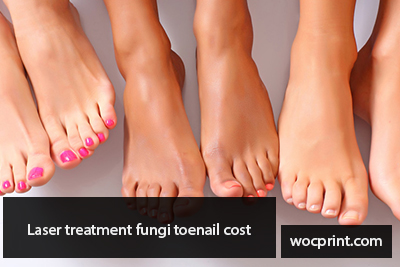 Laser treatment fungi toenail cost